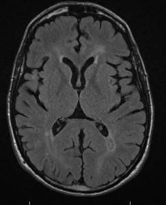 21March2015 periventricular T2 flair