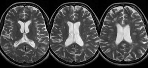 Multiple sclerosis MRI Brain
