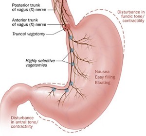 gastroparesis