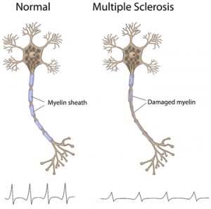 multiple_sclerosis_myelin