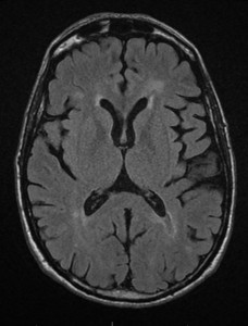 2016March12_T2AxialFlair Periventricular