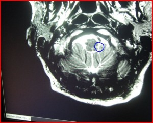 MedullaL