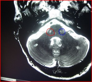 PontineLesions